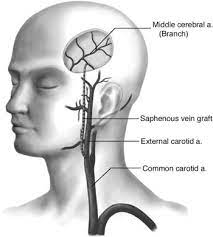 In the neck, each carotid artery branches into two divisions: External Carotid Artery An Overview Sciencedirect Topics