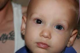 What You Need To Know To Help Your Child's Vision If They Have IP