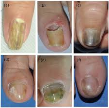 Image result for onychomycosis