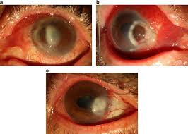 Treatment of noninfectious keratitis varies depending on the severity. Infectious Keratitis After Pterygium Surgery Eye