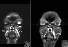 Dissolving Filler - Filler Nodules And Complication Management