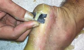 Pamper your feet with your favorite moisturizer. Youtube Video Of Man Removing A Callus Using Razor Blade Daily Mail Online