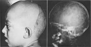 Crouzon's disease (craniofacial dysostosis) Modern diagnosis and treatment