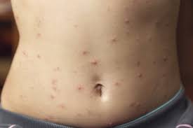 Image result for vyrážka u dětí