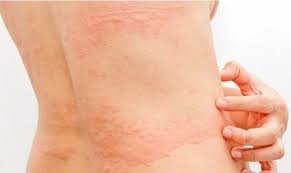 Image result for dermatitis contacta allergica