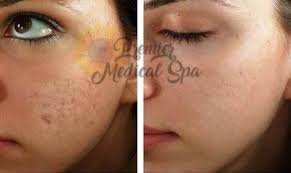 Maybe you would like to learn more about one of these? Microneedling Premier Medical Spa