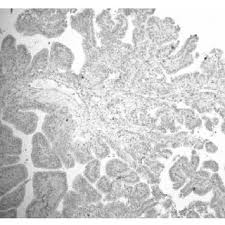 Games load so fast, and if you. Pdf Mesenchymal Hamartoma Of The Chest Wall In An Infant