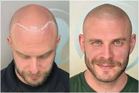 Top 13 Liverpool scalp micropigmentation artists compared