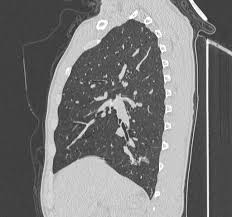 Image result for Broncholithiasis