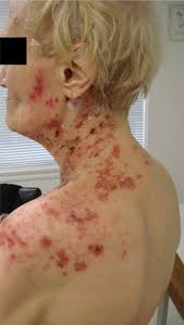 Image result for herpes zoster