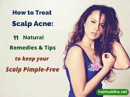 How To Treat Scalp Acne 11 Natural Remedies That Will Help Clear Up Scalp Pimples Hair Buddha Pimples On Scalp Scalp Acne Scalp Acne Treatment