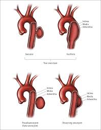 It arises when a segment of the vessel wall is weakened due to any number of factors and this causes a bulging. Aortic Aneurysms Aortic Diseases Vascular Diseases Peripheral Cardiovascular Diseases Diseases Mcmaster Textbook Of Internal Medicine