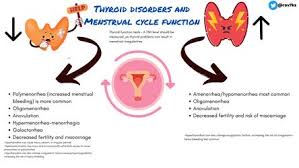 Image result for Galactorrhea