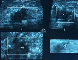 Except for skin cancer, breast cancer is the most common cancer in women in the united states. Sobrevivir Al Cancer De Mama Es Posible Prevencion Psicoterapia Queretaro