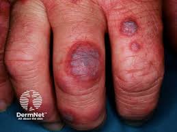Image result for Erythema Multiforme