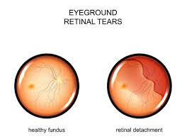 Retinal tears develop when the vitreous pulls on the retina while retinal holes develop due to progressive thinning of the retina. Retinal Tears Ophthalmologist In San Diego Ca Anderson Family Ophthalmology