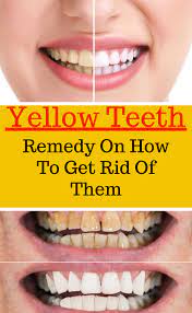 Yellow Teeth Remedy On How To Get Rid Of Them Yellow Teeth Remedy Teeth Remedies Yellow Teeth