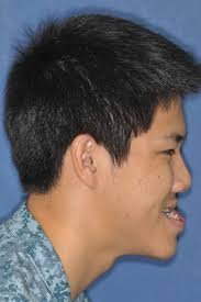 Rediscovering My Self-Esteem through Reconstructive Jaw Surgery