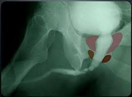 Image result for Voiding Cystourethrogram