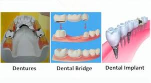 Which Type Of Tooth Replacement Is Best Tooth Replacement Dental Bridge Dental Implants
