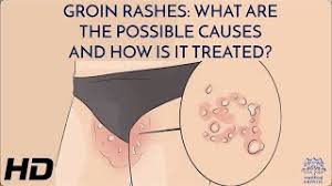 Image result for sore skin in the groin area