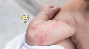 Ketahui Arti Bintik Merah Pada Kulit Bayi Mulai Dari Ringan Hingga Berisiko