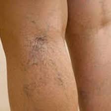 Banyak berlaku pada orang perempuan. Penyebab Vena Varikos Varicosities