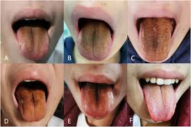 Image result for black hairy tongue symptoms