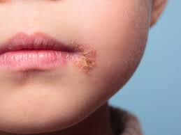 Prevention tips include not touching the face, avoiding acne can appear around the mouth, but a person may get occasional pimples in this area even if wipe the mouth after eating. Baby Acne Causes Diagnosis And Treatment