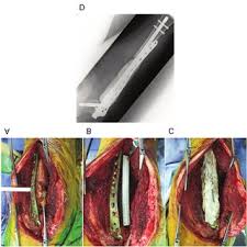 Firmele fictive nu le ia la purificat? Pdf Salvage Reconstruction With The Masquelet Technique Following Wide Resection For Chondrosarcoma Of The Proximal Femoral Metaphysis A Case Report