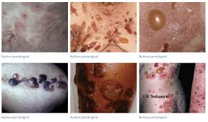 Image result for Pemphigoid