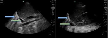 I also thought that chf was bilateral pleural effusion but i guess you can have unilateral too. A Fast Diagnosis Brown Emergency Medicine