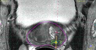 The doctor can&#x27;t feel the tumor or see it with an imaging test such as transrectal ultrasound (it was either found during a transurethral resection of the prostate (turp) or was diagnosed by needle biopsy done for a high psa) ct1. How Prostate Cancer Care Can Be Personalized Every Step Of The Way Blog Philips