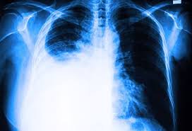 Pleural effusion refers to a buildup of fluid in the space between the lungs and the chest cavity. Pleural Effusion Treatment Causes Symptoms Prognosis