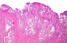 D'autres affections médicales peuvent causer les mêmes. Cancer De L Endometre Wikipedia