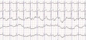 Tahicardia se produce atunci când o anormalitate la nivelul inimii produce semnale electrice rapide. Palpitatiile Perceptia Constienta A Batailor Inimii