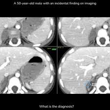 Image result for Incidental Imaging Finding