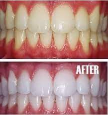 Blanqueamiento Poner Un Poco De Pasta De Dientes En Una Taza Pequena Mezcle En Una Cucharad Recetas De Belleza Blanqueador De Dientes Tratamientos De Belleza