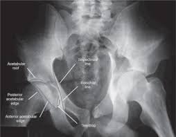 Maybe you would like to learn more about one of these? Proposal For Standardization Of Radiographic Studies On The Hip And Pelvis Sciencedirect
