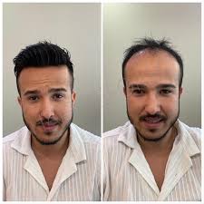 Hair Reform Saclandirma Sistemleri Ana Sayfa Facebook