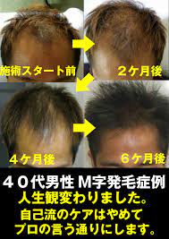 美容 おしゃれまとめの人気アイデア pinterest yasui 発毛 薄毛 aga 治療