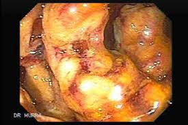 Image result for Megacolon
