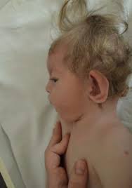 Wolf-Hirschhorn Syndrome: Clinical and Genetic Study of 7 New Cases, and  Mini Review