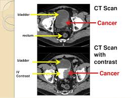 As metal interferes with the during the scan. Can You See Bladder Cancer On Ct Scan Ct Scan Machine