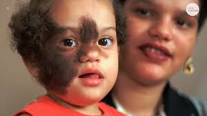 Learn with flashcards, games and more — for free. Odd Medical Conditions Werewolf Syndrome Black Hairy Tongue