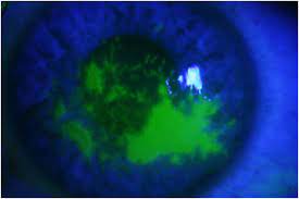 Recurrences are common and may lead to corneal hypoesthesia, ulceration, permanent scarring, and decreased vision. Herpes Simplex Epithelial Keratitis Associated With Daily Disposable Contact Lens Wear Sciencedirect