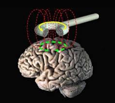 21 cfr 882.5805 repetitive transcranial magnetic stimulation (rtms) system. Transkranielle Magnetstimulation Wikipedia