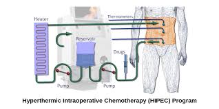 hyperthermic intraperitoneal chemotherapy hipec jwci