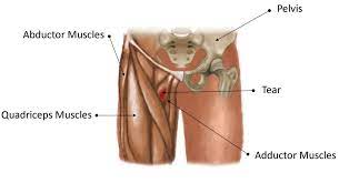 Oblique depression of the body between the abdomen and thighs, 1590s, earlier grine the architectural groin curving edge formed by the intersection of two vaults is from 1725. Pt Weekly Groin And Hamstring Injury In An Athlete Physiotherapy Focus