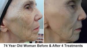 Can microneedling cause temporary hair shedding : Shedding Microneedling Faq Website I Tried It To Find Out